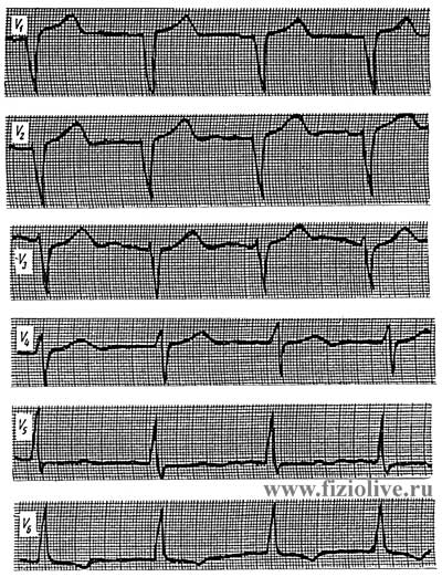 Electrocardiogram 2 in left ventricular hypertrophy