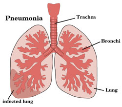наступление пневмонии