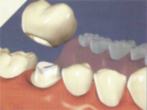 имплонтанты зубов